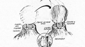 Schémas de la greffe imaginée par le neurochirurgien américain Robert J. White dès 1971